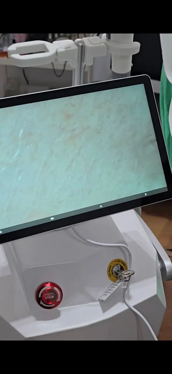 Detaljan prikaz rada kamere tokom laserske epilacije